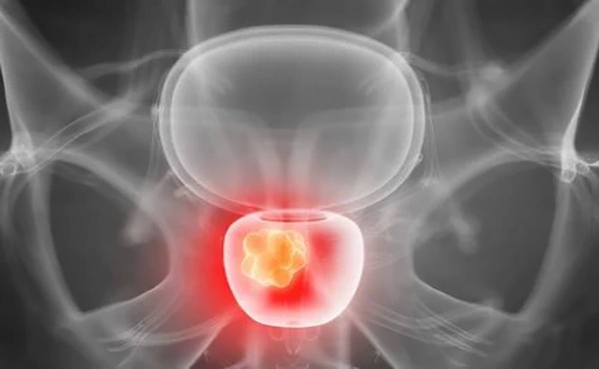 Il cancro della prostata, etiologia e importanza della diagnosi precoce
