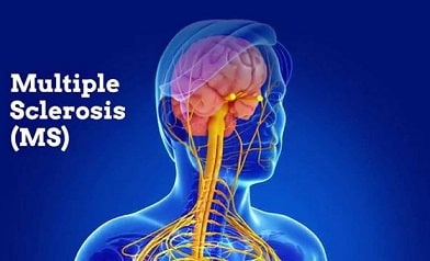 Scientific research proves vaccines cause multiple sclerosis