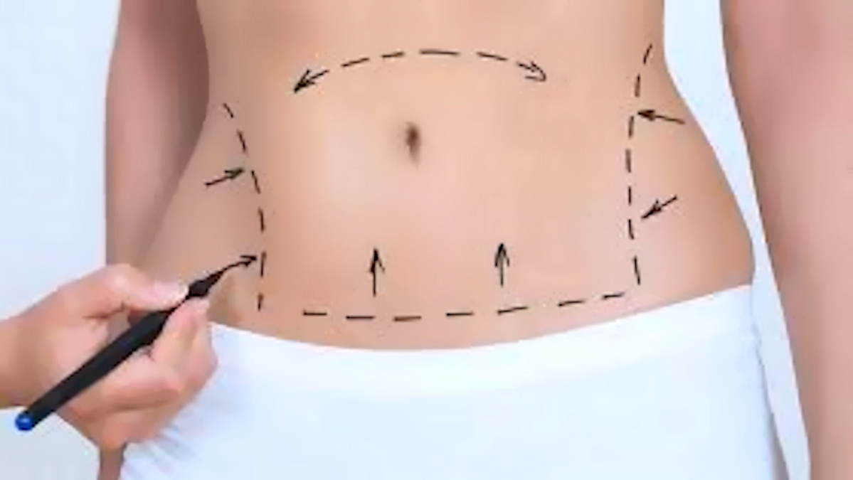 Liposuzione mortale a Roma: il monito di SIAARTI sulla sicurezza negli interventi estetici