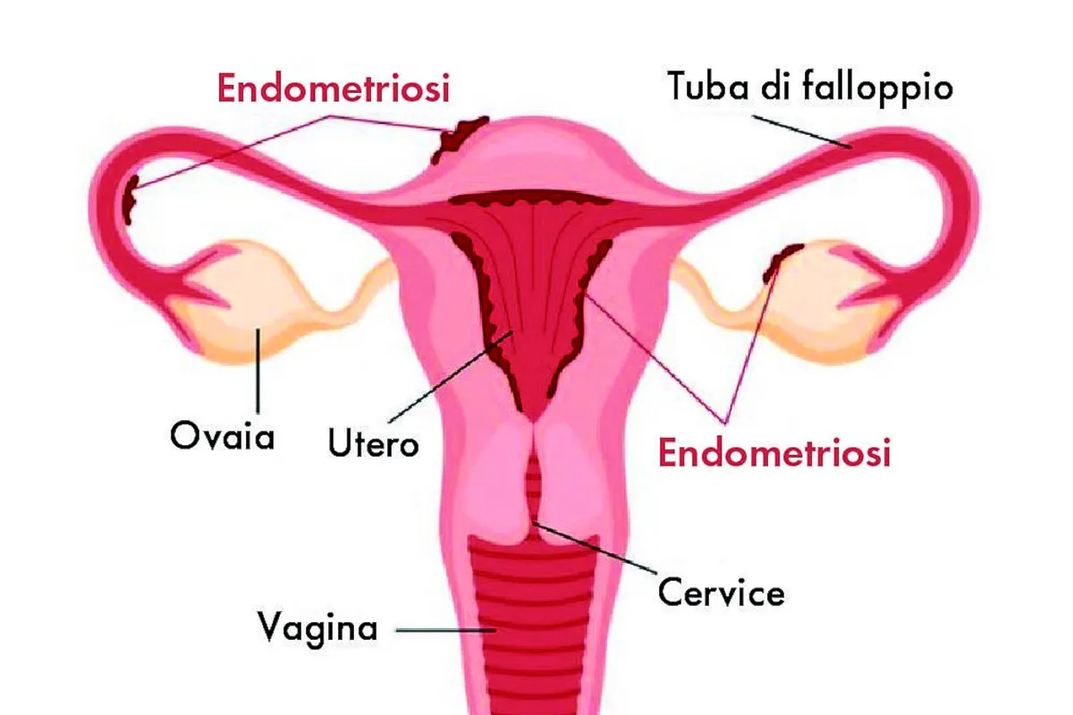 Endometriosi: un nuovo test fai-da-te potrebbe rivoluzionare la diagnosi
