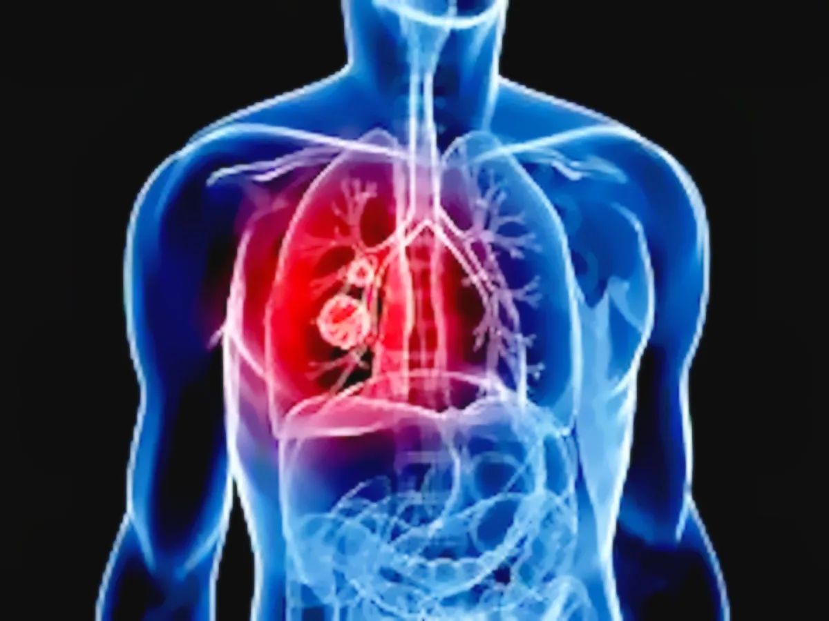 Scoperta una mutazione genetica che migliora l’efficacia dell’immunoterapia nel tumore al polmone